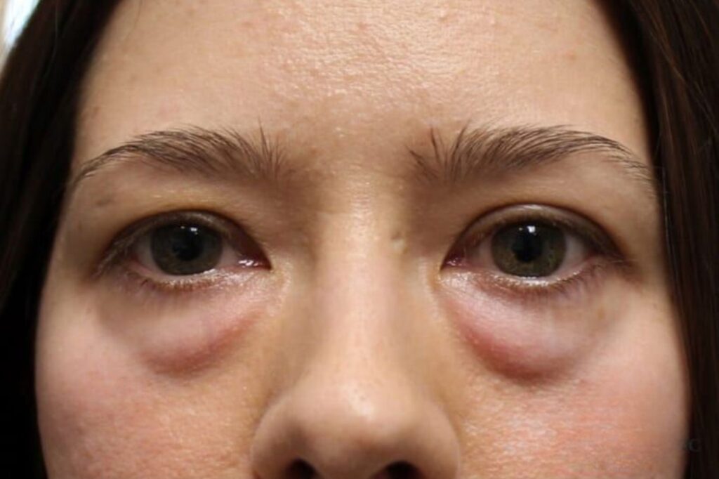 Ptosis (Drooping Eyelid ) Surgery