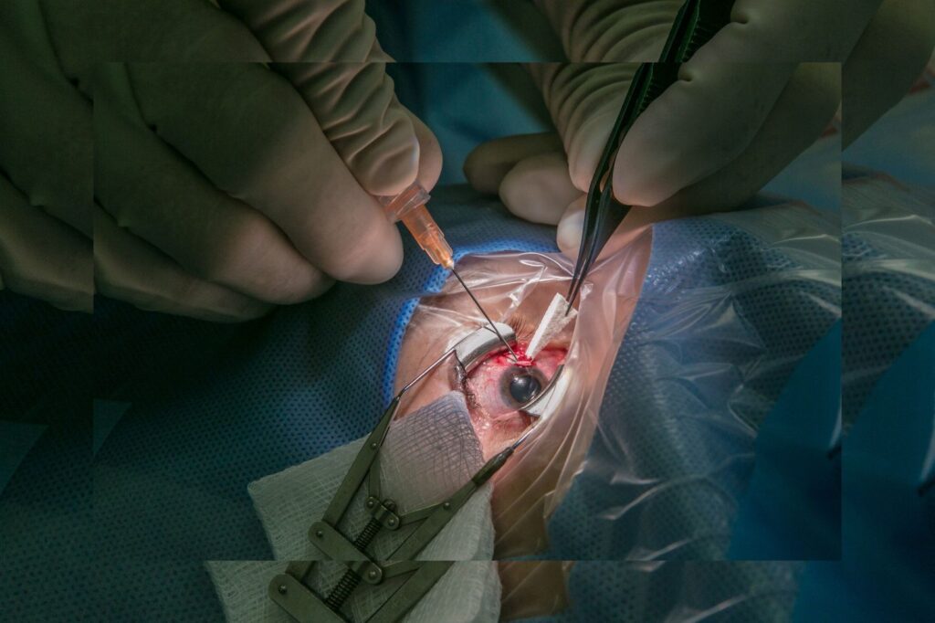Stitch-less Cataract Surgery
