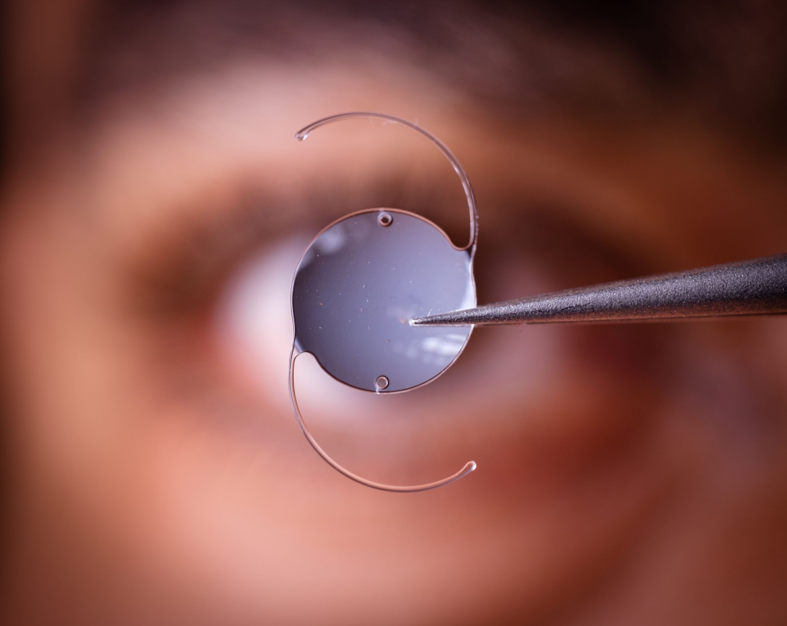 Close-up of an intraocular lens held by tweezers with a blurred background of an eye.