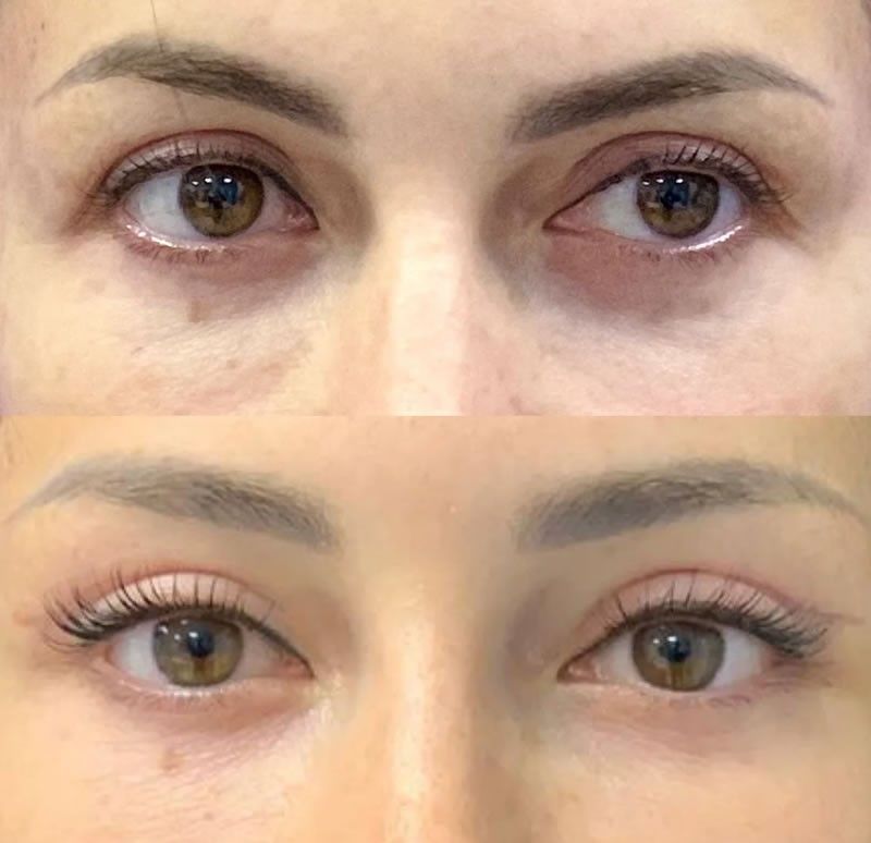Oculoplasty treatment at Namokar Eye Care