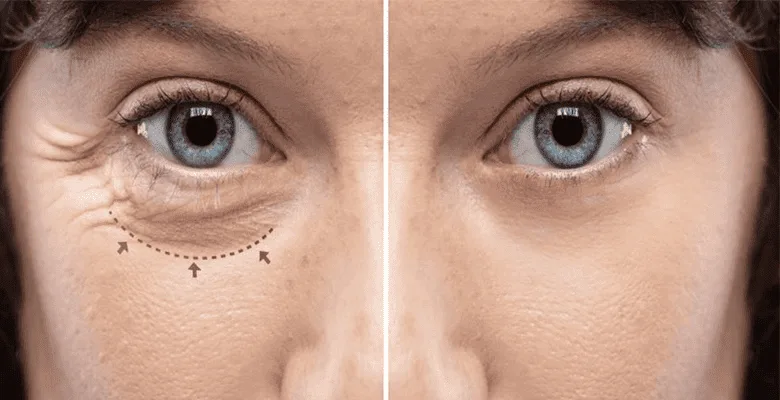 Oculoplasty care at Namokar Eye and Oculoplasty Centre