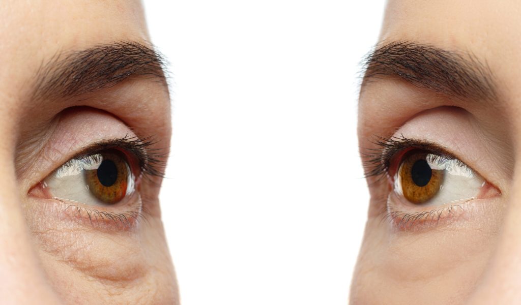 Anti aging treatment. Comparison of female eyes before and after rejuvenation.