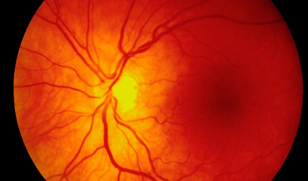 Fundus photography involves photographing the rear of an eye (also known as the fundus). The main structures that can be visualized on a fundus photo are the central and peripheral retina, optic disc and macula.